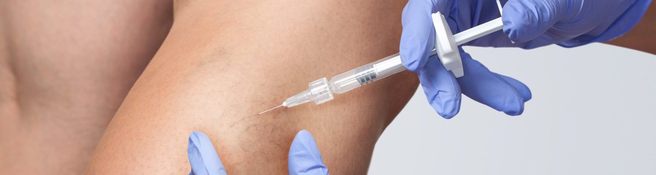 skleroterapia-min